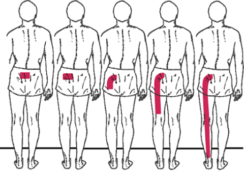 Sciatica | David Berro